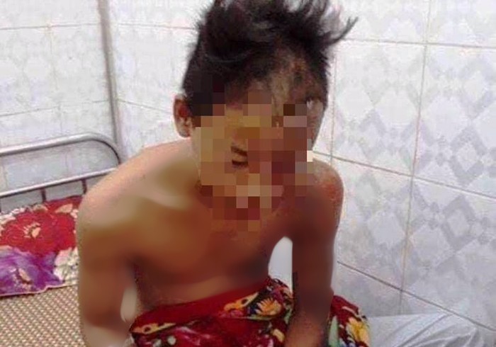 Nam sinh 15 tuổi may mắn thoát chết khi bị sét đánh cháy sém đầu