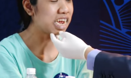 Cô gái "người khỉ" 22 năm há miệng