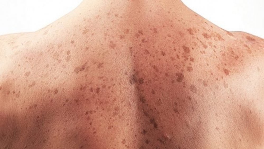 Làm việc lâu dưới trời nắng nóng kéo dài, cẩn thận ung thư da - Ảnh 1.