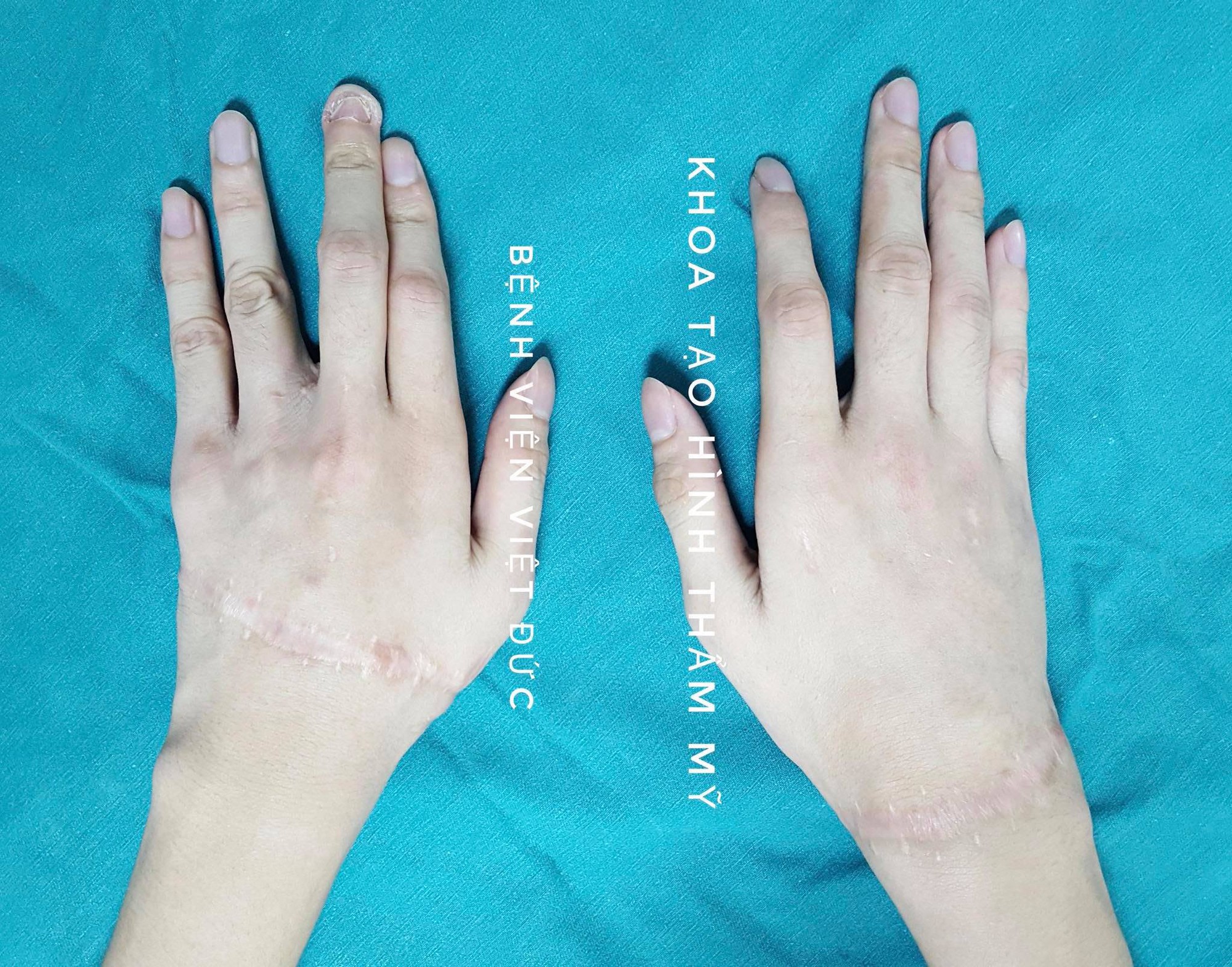 Thanh niên 19 tuổi gõ máy tính nhoay nhoáy sau nối liền hai bàn tay đứt rời