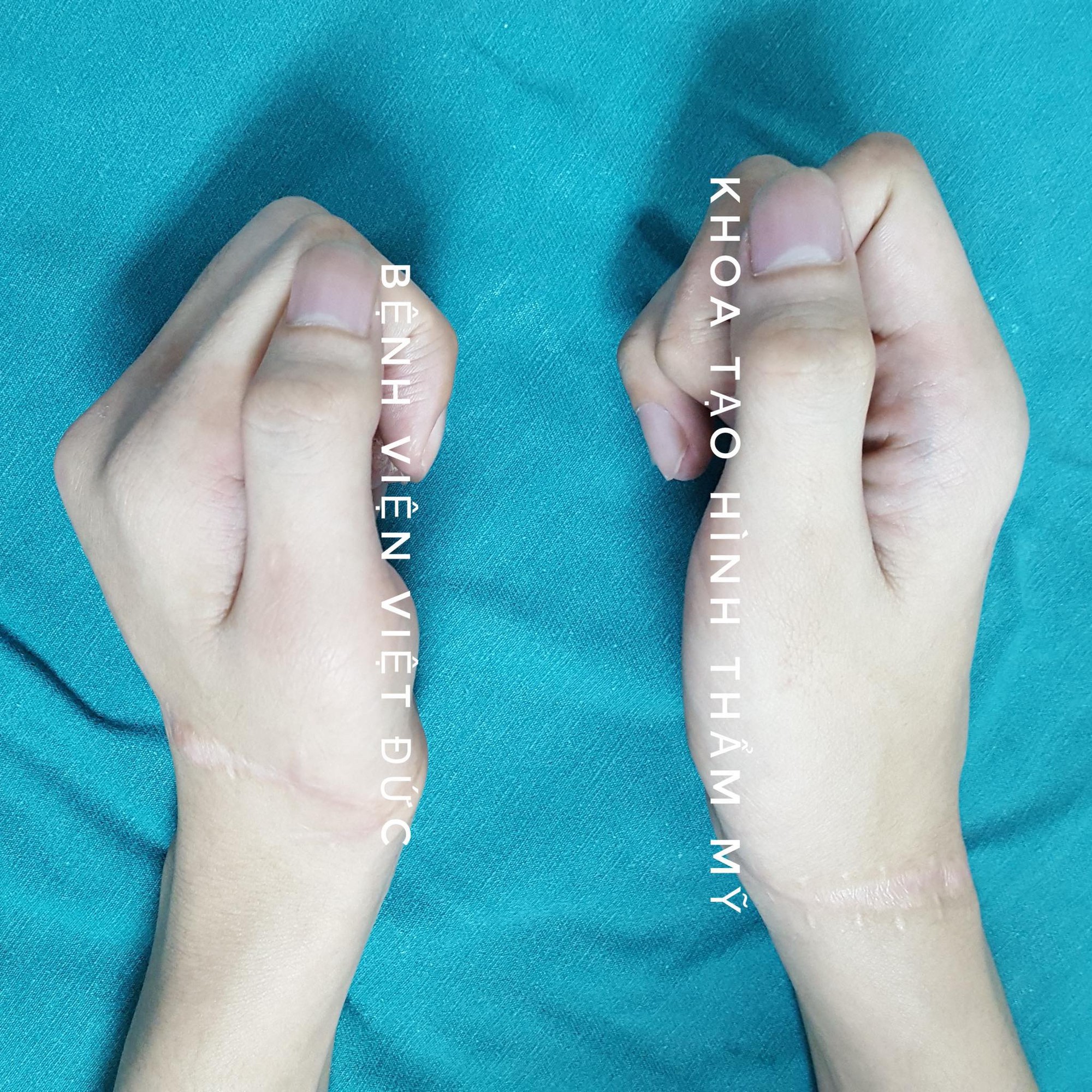 Thanh niên 19 tuổi gõ máy tính nhoay nhoáy sau nối liền hai bàn tay đứt rời - Ảnh 2.