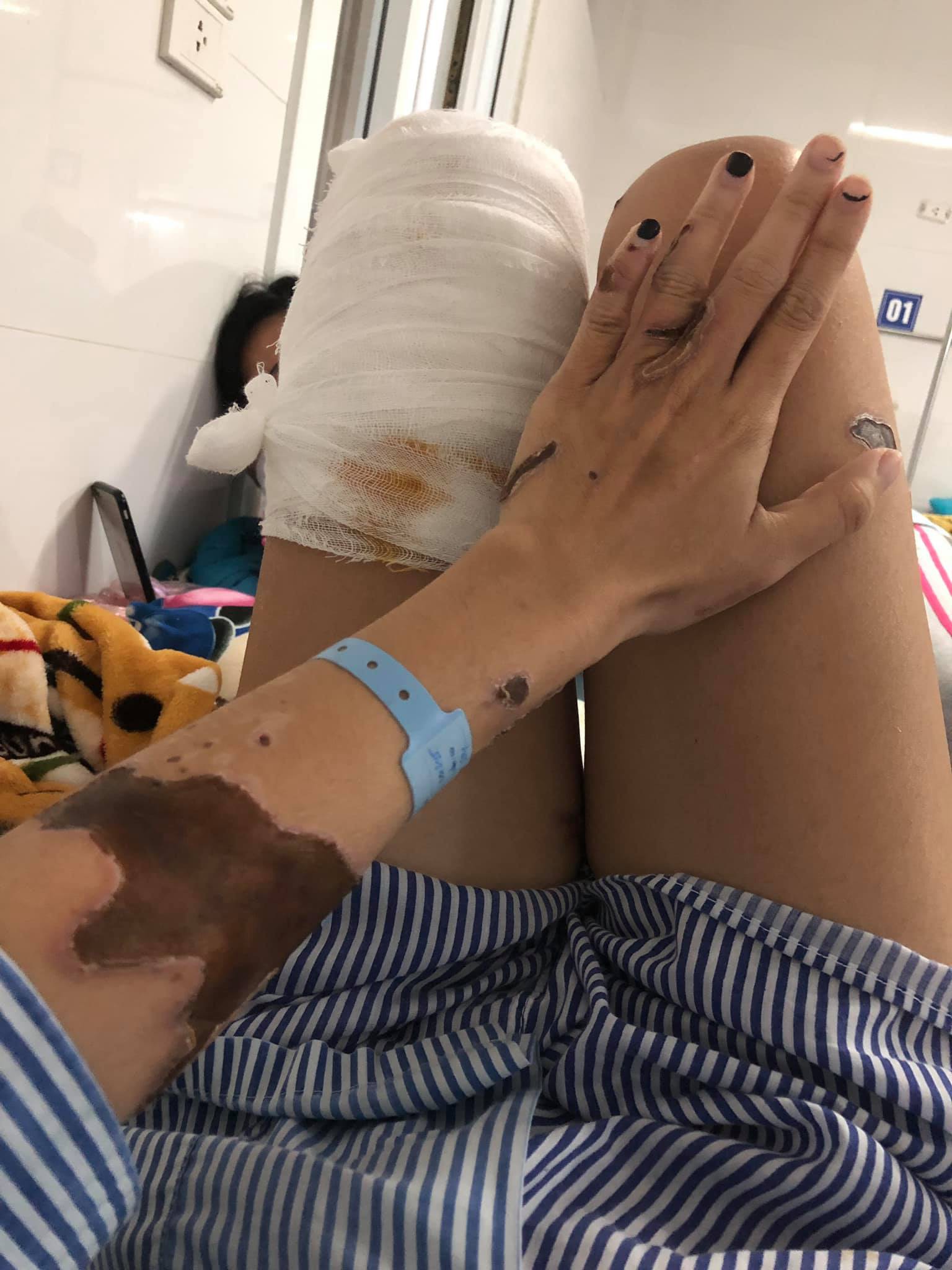 Đ&atilde; khởi tố, bắt tạm giam thiếu &uacute;y c&ocirc;ng an tạt axit vợ sắp cưới ở Đ&agrave; Nẵng - Ảnh 1.