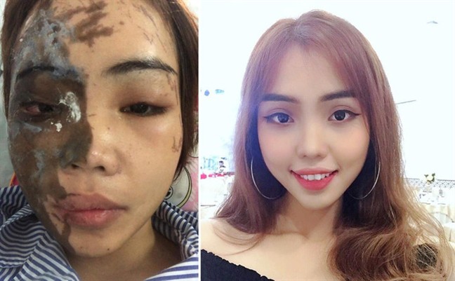 Tạt axit hủy hoại vợ vì ghen: tận cùng cái ác!