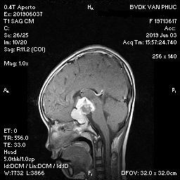 Kỳ lạ bé gái mắc chứng hay nhớ, hay quên
