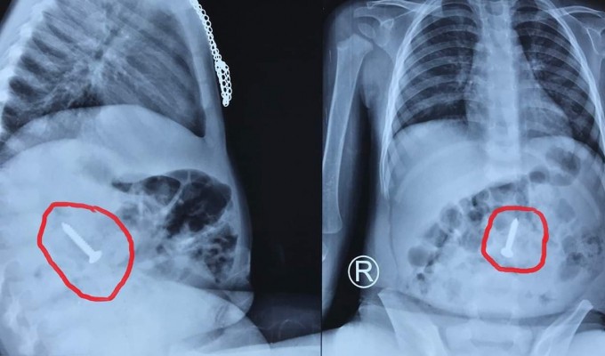 Đinh vít bằng sắt dài 3,5 cm nằm trong tá tràng cháu bé 20 tháng tuổi