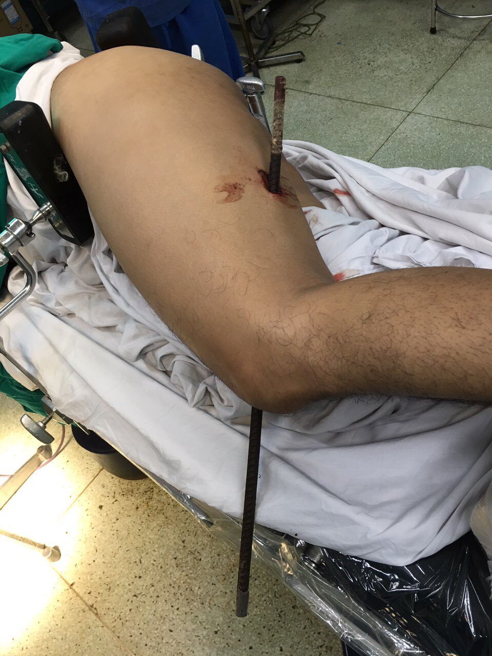 Rơi từ độ cao 5 mét rồi dính chặt luôn vào thanh sắt