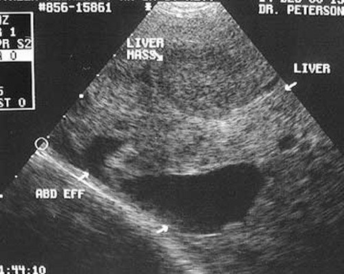 Cắt bỏ khối u máu gan khổng lồ cứu nữ bệnh nhân