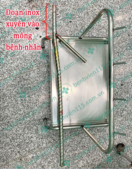 Thanh niên nhập viện cùng thanh inox cả mét xuyên vào mông
