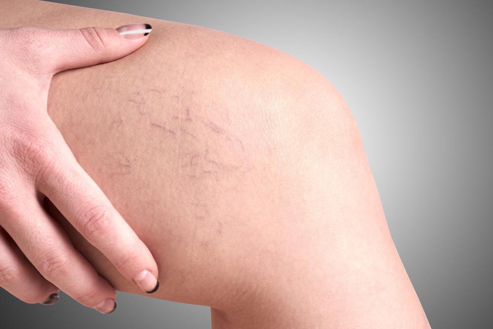 Mạch máu vằn vện, hay chuột rút: Có thể tắc mạch chết người?