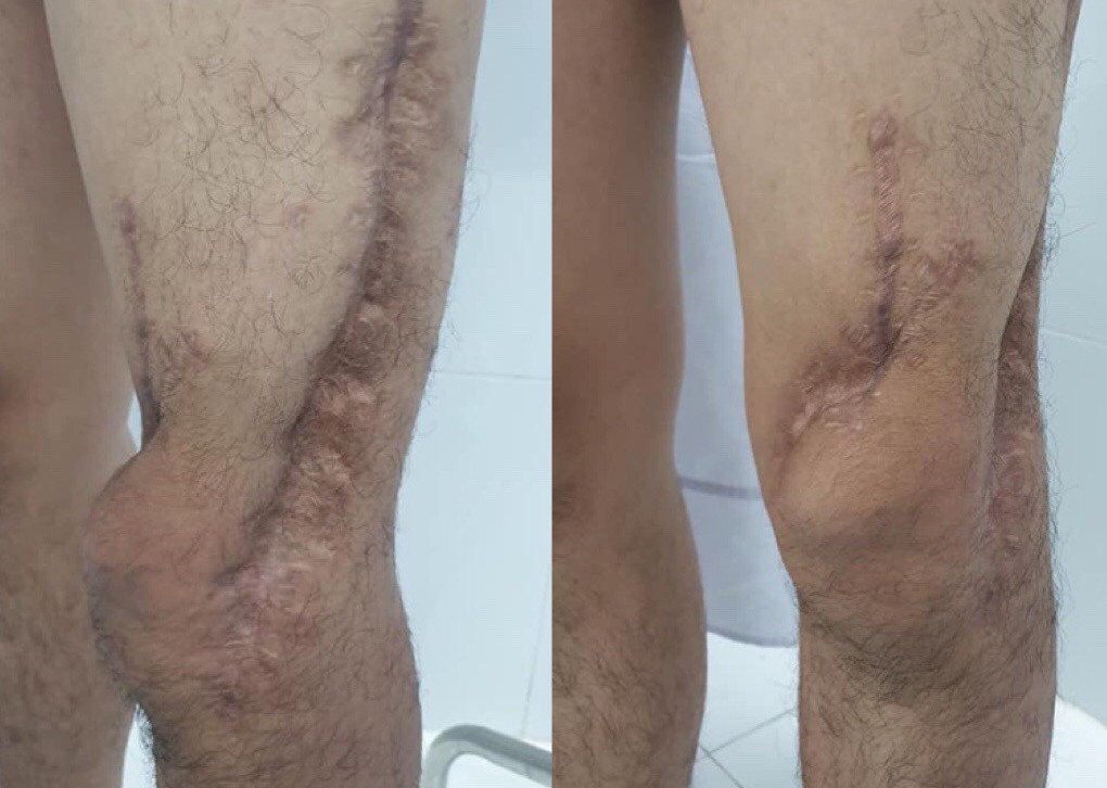 Nam sinh viên được phẫu thuật 6 lần "cứu" chân suýt phải cắt cụt