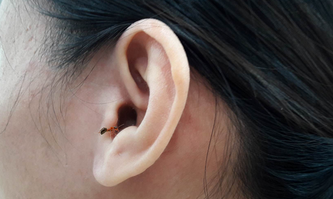 Nam thanh ni&ecirc;n bị gi&aacute;n chui v&agrave;o tai trong l&uacute;c ngủ - Ảnh 2.