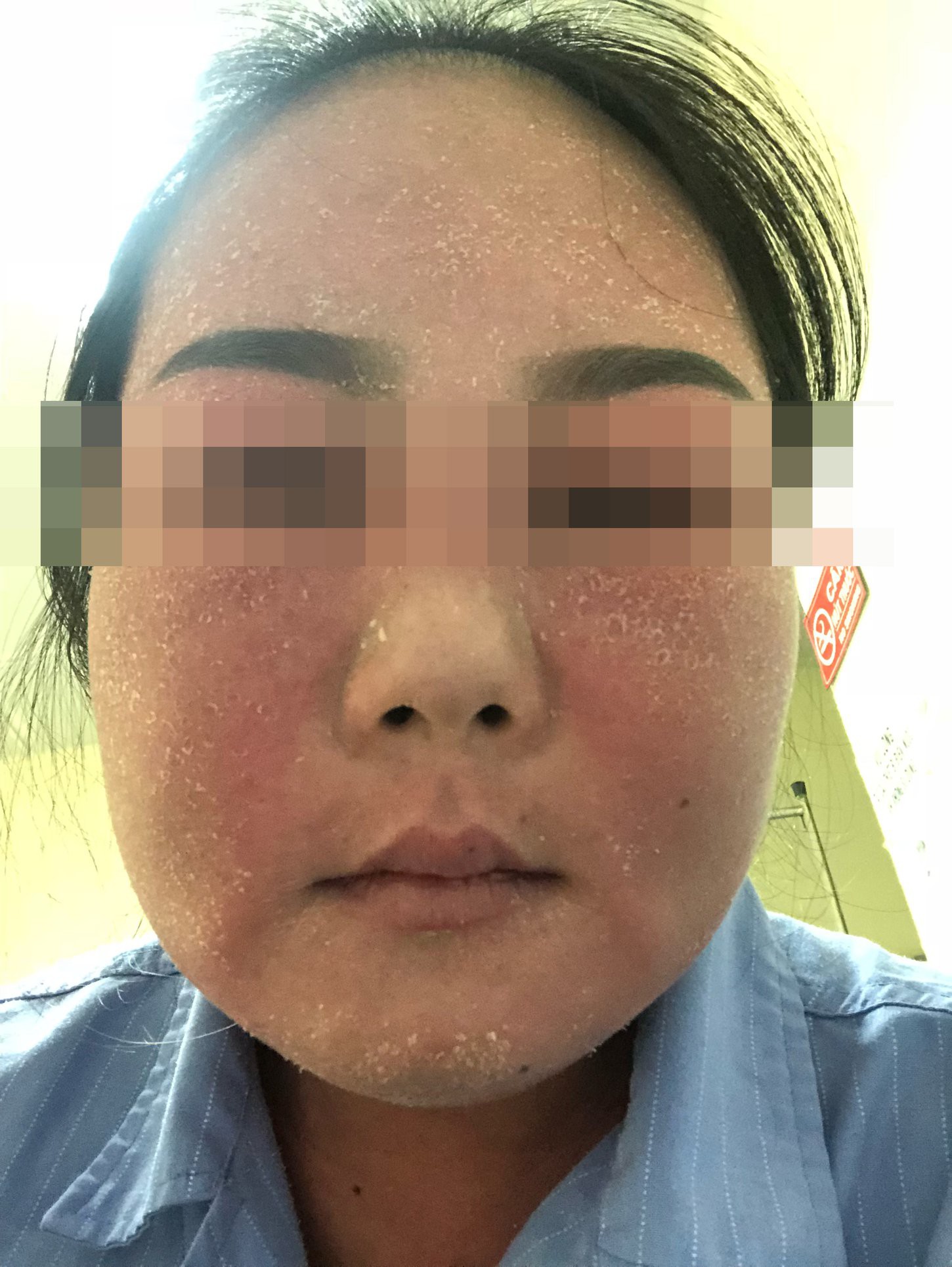 Tẩy trắng da, cô gái trẻ nhập viện cấp cứu