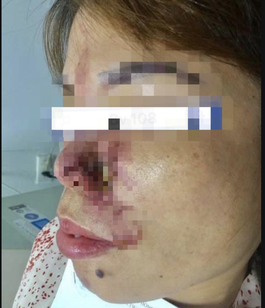 Mũi c&ocirc; g&aacute;i mưng mủ, hoại tử sau ti&ecirc;m filler - Ảnh 2.