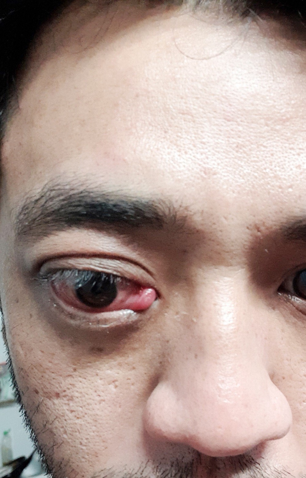 Lồi mắt sau 2 năm bị tai nạn giao thông