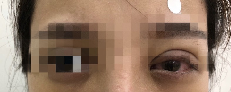 Mắt mờ dần sau nhấn m&iacute; ở tiệm spa, c&ocirc; g&aacute;i hoảng hốt khi b&aacute;c sĩ t&igrave;m thấy nguy&ecirc;n nh&acirc;n - Ảnh 2.