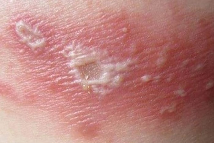 Chữa nấm v&ugrave;ng k&iacute;n bằng nọc kiến ba khoang, thanh ni&ecirc;n 20 tuổi nhập viện cấp cứu - Ảnh 2.