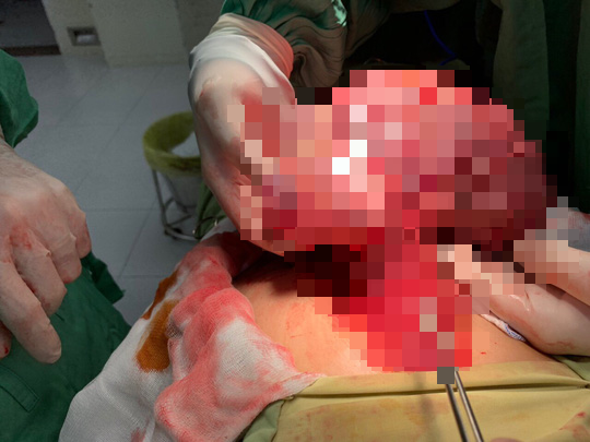 Nữ bệnh nh&acirc;n su&yacute;t chết khi bất ngờ tăng 7kg trong 3 th&aacute;ng - Ảnh 1.