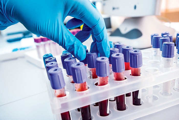 Phát hiện cholesterol "xấu xí" vô cùng đáng sợ
