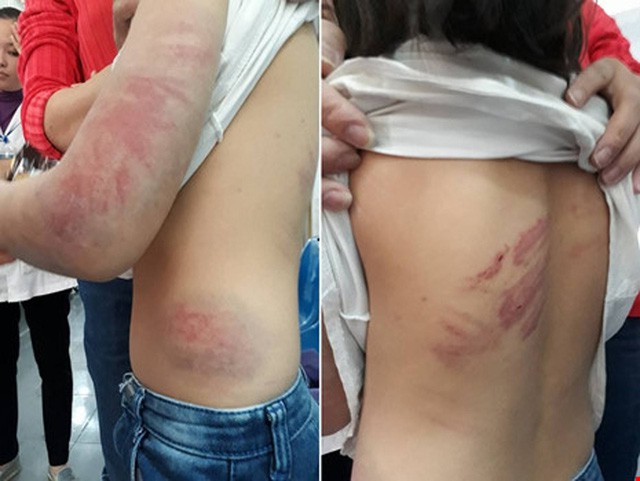 Vợ bỏ đi 4 năm, chồng nhiều lần hành hạ dã man con ruột 6 tuổi