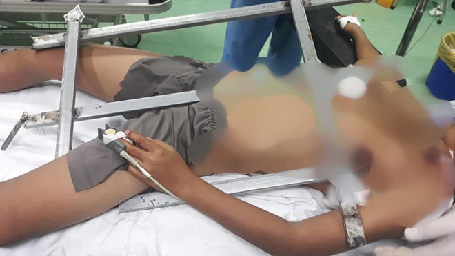 Rơi từ cây cao khi chơi trốn tìm, bé trai bị hàng rào sắt đâm xuyên ngực