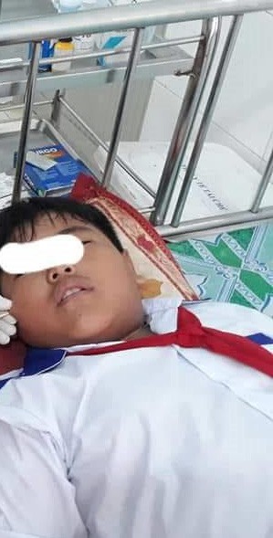 Chuyện hy hữu: Cây xiên que đâm xuyên mặt 1 học sinh lớp 4