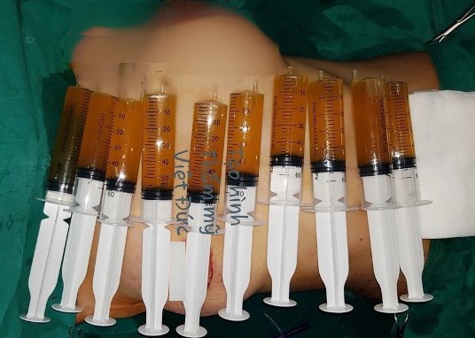 Sau n&acirc;ng ngực, người mẹ trẻ h&uacute; hồn v&igrave; ngực tr&aacute;i bất ngờ to như tr&aacute;i b&oacute;ng bay - Ảnh 1.