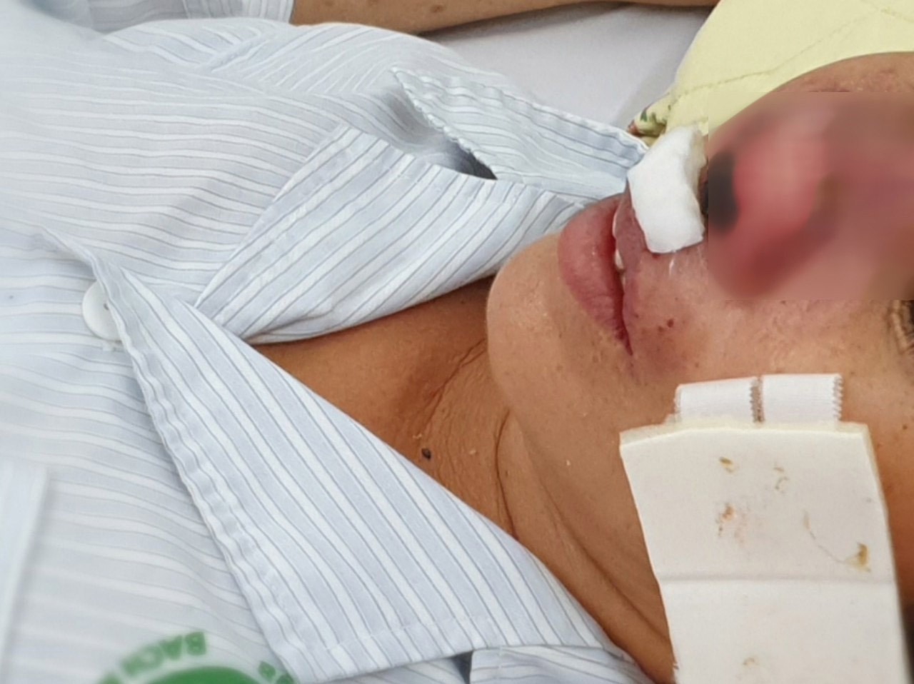 Người phụ nữ bị "vi khuẩn lãng quên" ăn vẹt cánh mũi