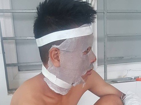 Chùm bóng bay phát nổ trên sân, 3 cầu thủ U14 CLB Sông Lam Nghệ An nhập viện