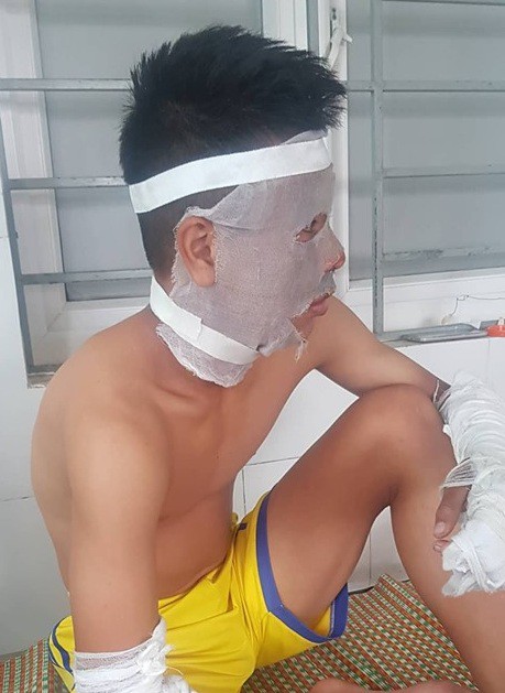 Ch&ugrave;m b&oacute;ng bay ph&aacute;t nổ tr&ecirc;n s&acirc;n, 3 cầu thủ U14 CLB S&ocirc;ng Lam Nghệ An nhập viện - Ảnh 1.