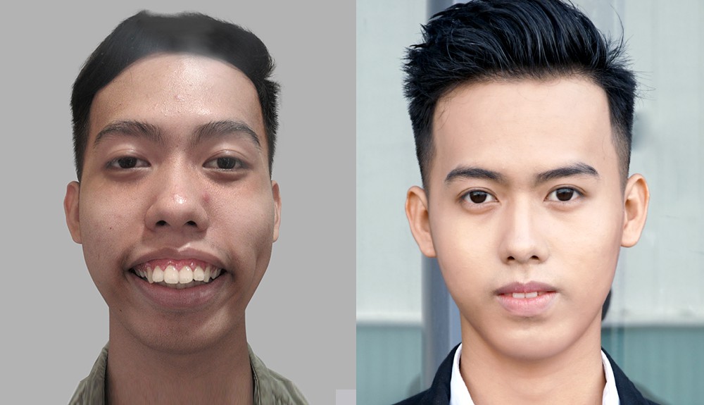 Nam sinh viên "nạo dừa" vỡ òa hạnh phúc sau cắt hàm