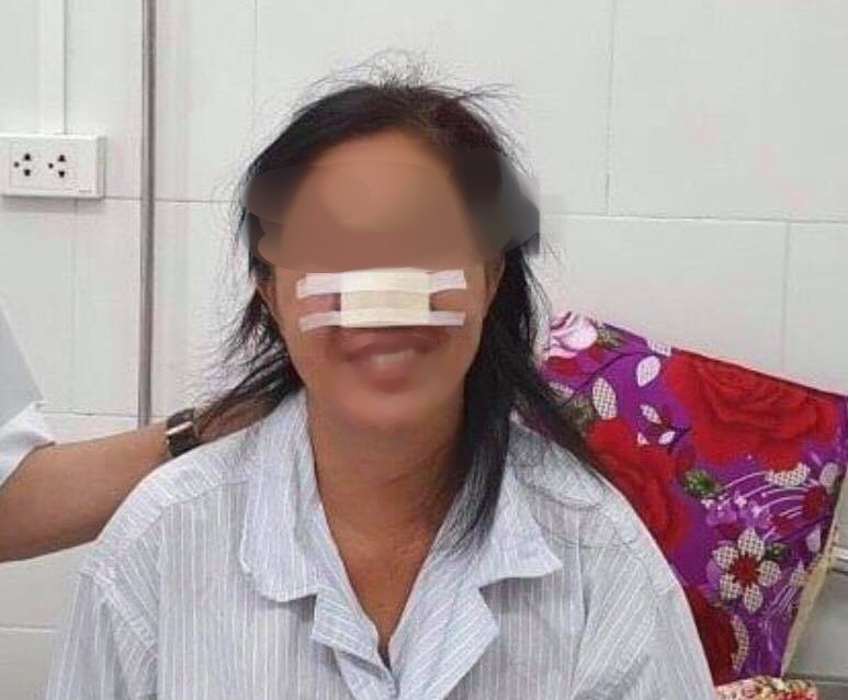 Nữ bệnh nhân bị "vi khuẩn ăn thịt người" Whitmore "ăn" vẹt cánh mũi