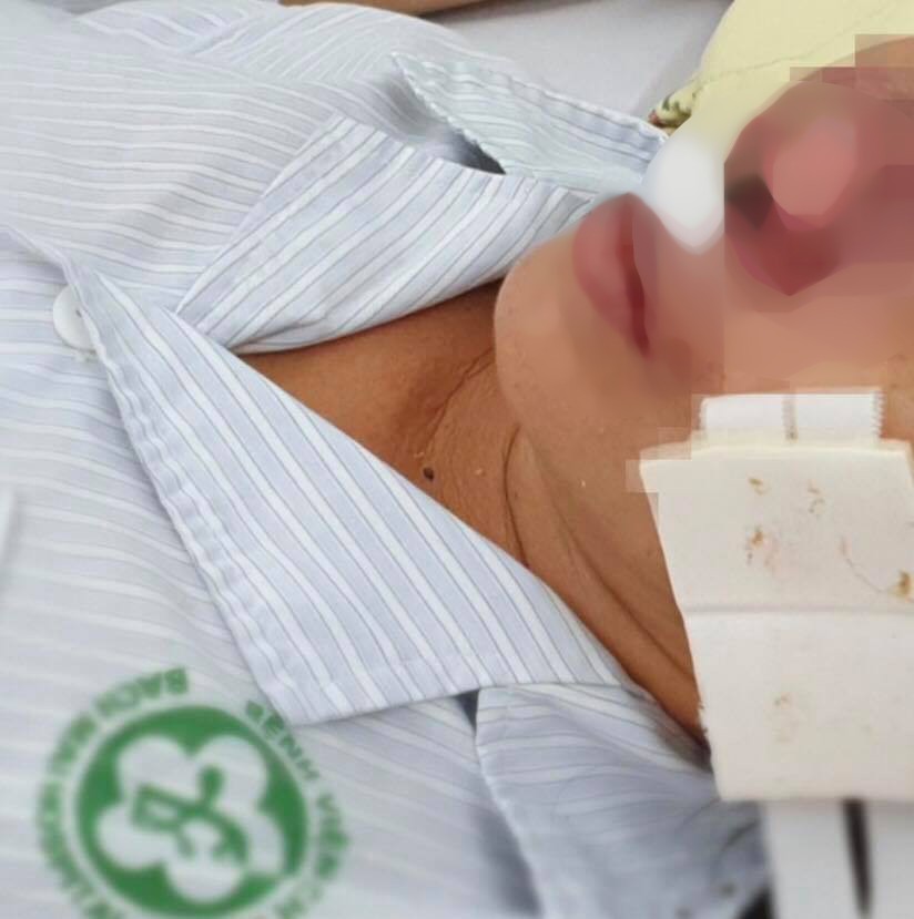 Nữ bệnh nh&acirc;n bị vi khuẩn ăn thịt người Whitmore ăn vẹt c&aacute;nh mũi - Ảnh 2.