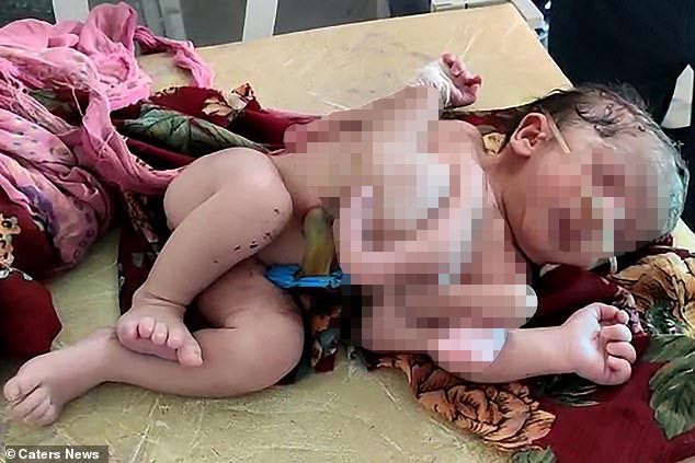 Bé gái chào đời với bốn chân và ba tay ở Ấn Độ