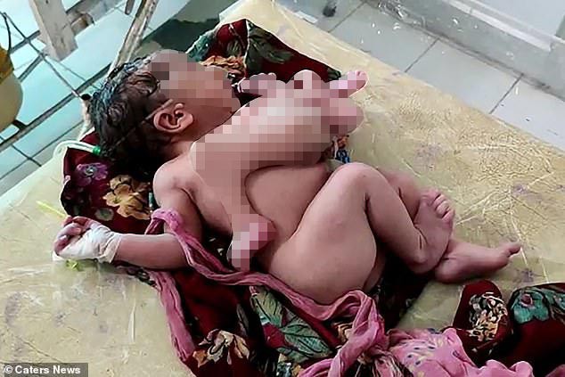 B&eacute; g&aacute;i ch&agrave;o đời với bốn ch&acirc;n v&agrave; ba tay ở Ấn Độ - Ảnh 2.