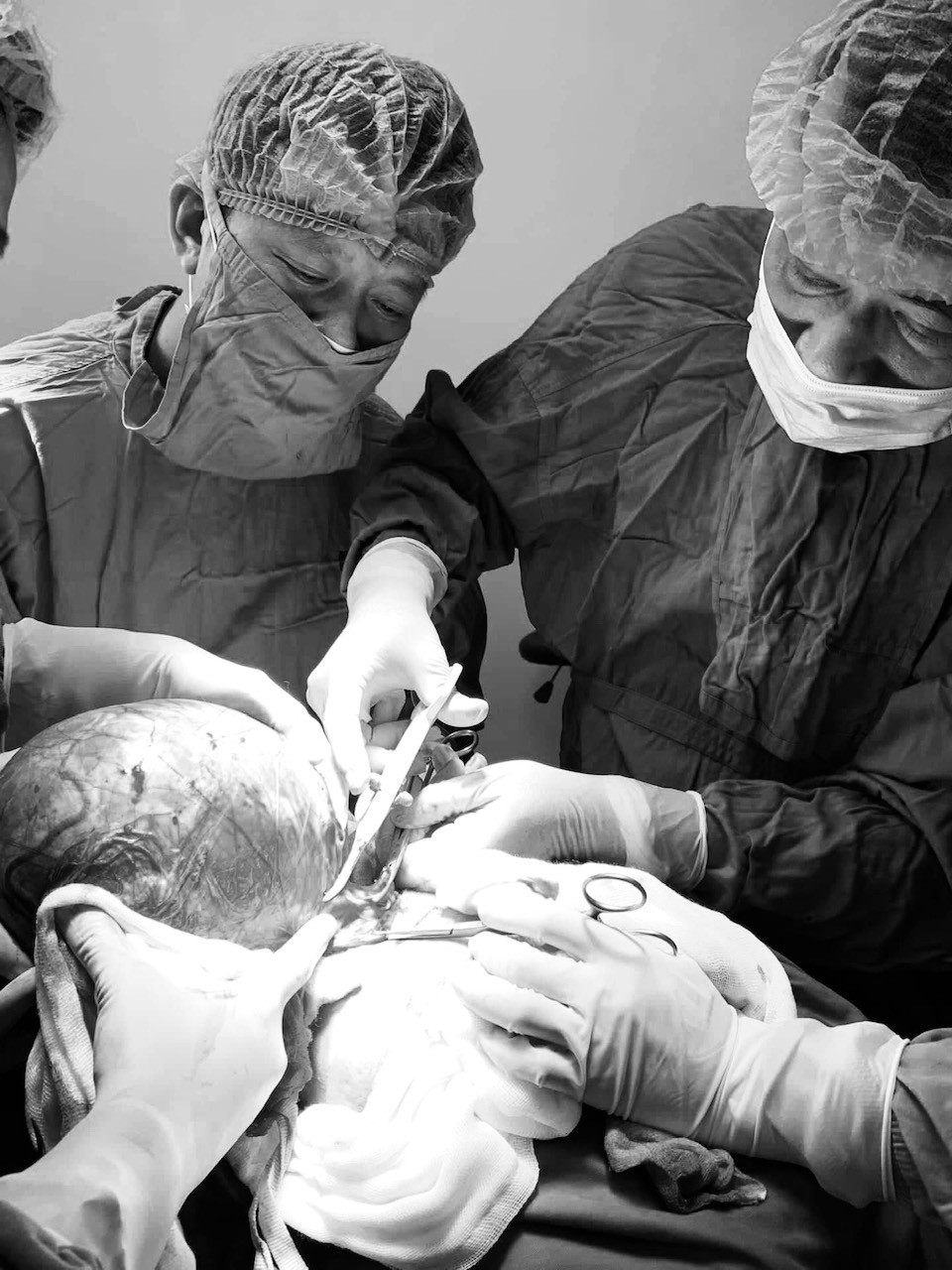 Đeo khối u tuyến gi&aacute;p to hơn quả bưởi ở cổ suốt cả chục năm - Ảnh 2.
