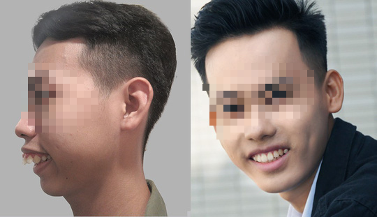 Nam sinh vi&ecirc;n nạo dừa vỡ &ograve;a hạnh ph&uacute;c sau cắt h&agrave;m - Ảnh 1.