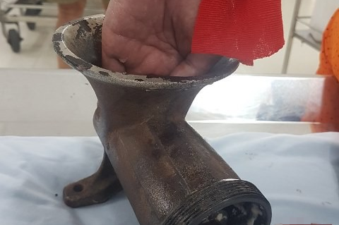Một phụ nữ bị máy xay thịt "nuốt" gần hết bàn tay