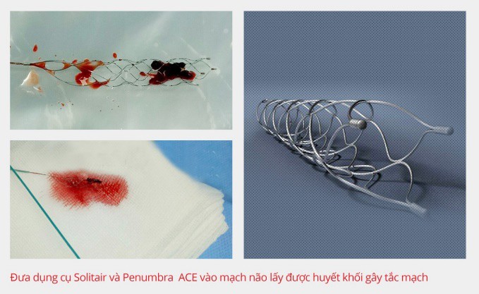 Bệnh viện Gia An 115 kịp thời cứu bệnh nh&acirc;n bị tắc động mạch n&atilde;o - Ảnh 1.