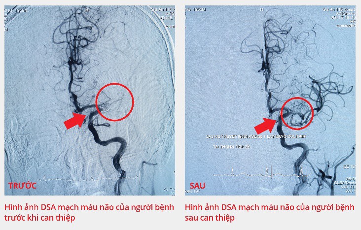 Bệnh viện Gia An 115 kịp thời cứu bệnh nhân bị tắc động mạch não