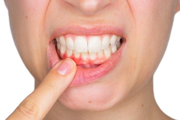 Nướu bị sưng có thể là do 8 lý do không ngờ