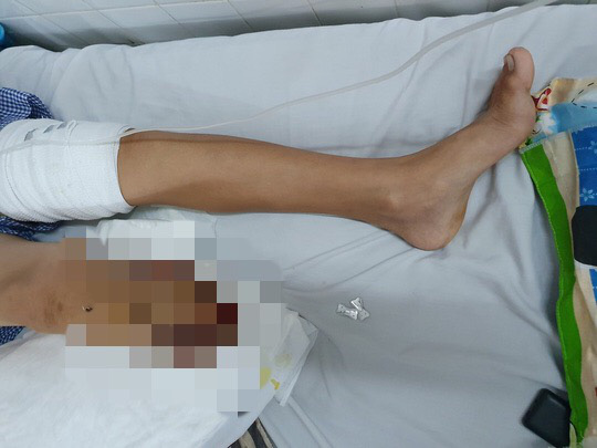 Bác sĩ xót xa xuống dao cắt bỏ chân bệnh nhi sau 4 lần phẫu thuật