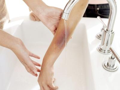 Sơ cứu người bị tai nạn do pháo nổ