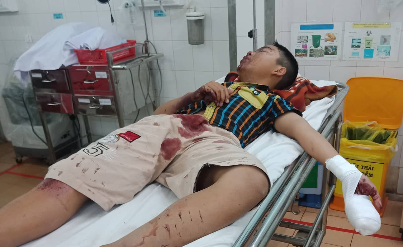 Đốt pháo, thiếu niên bị nổ nát bàn tay