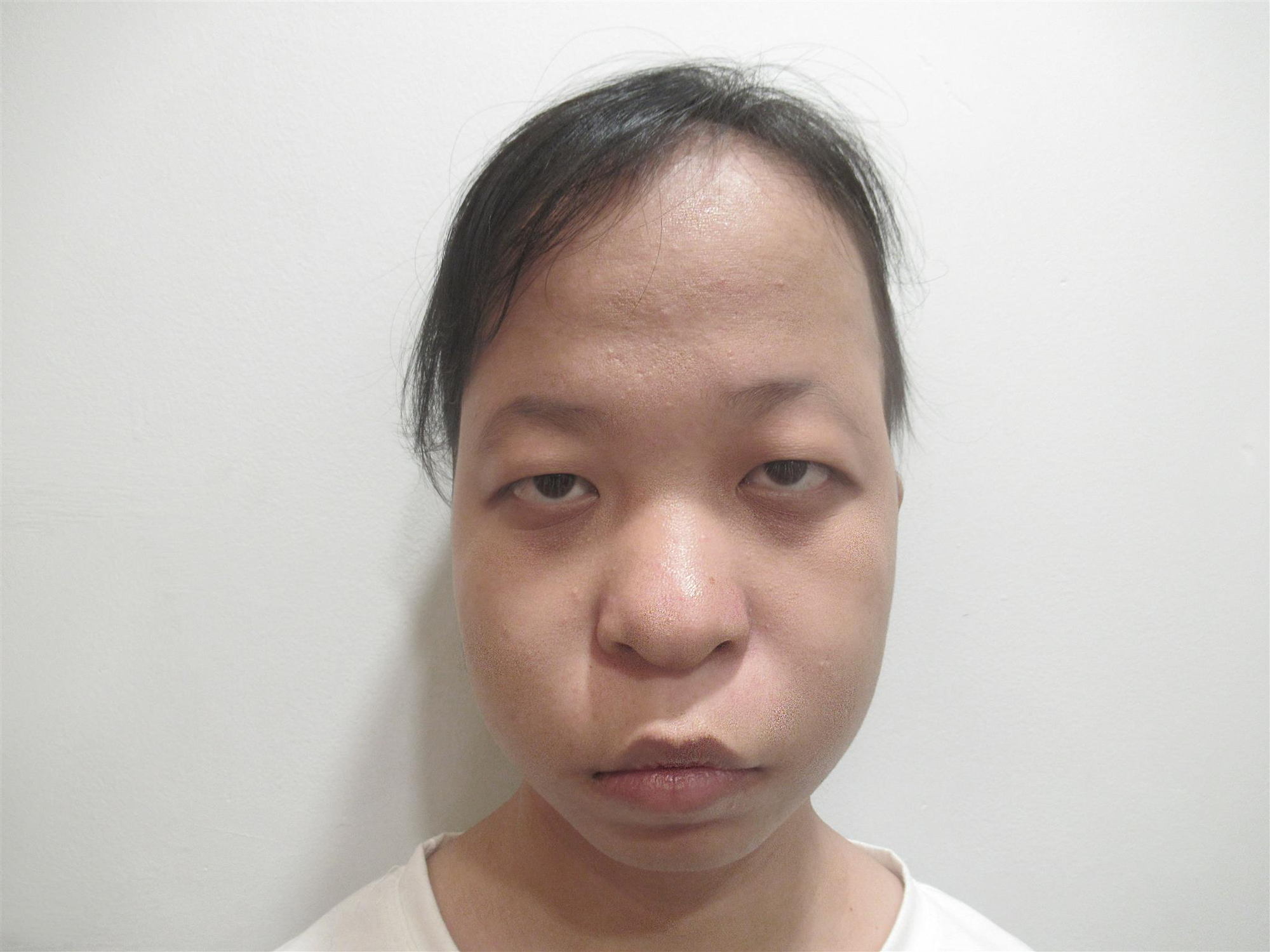 Nước mắt hạnh phúc của cô gái sau 19 năm hói đầu bẩm sinh