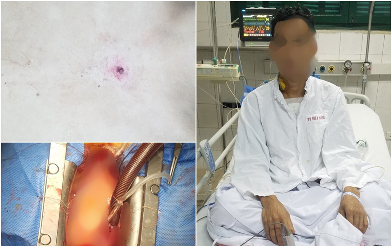 Sửa súng săn, người đàn ông bị đạn găm vào động mạch chủ ở ngực