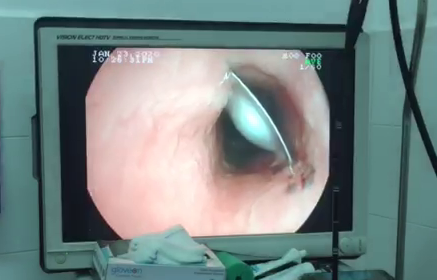 CLIP: Bệnh nhân cao huyết áp suýt trả giá đắt do uống thuốc quá nhanh
