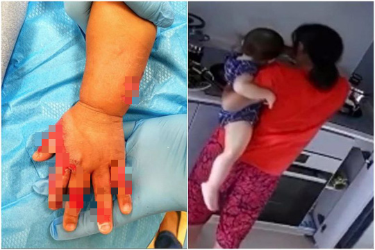 Bắt người giúp việc nhúng tay trẻ vào nồi lẩu đang sôi