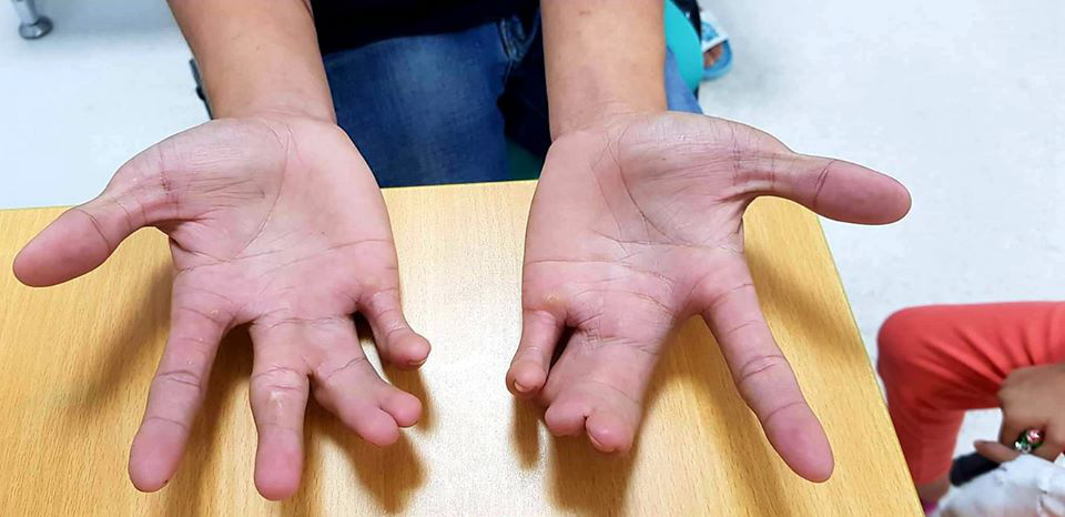 Một d&ograve;ng họ ở Tiền Giang bị dị tật c&agrave;ng cua hiếm gặp - Ảnh 2.