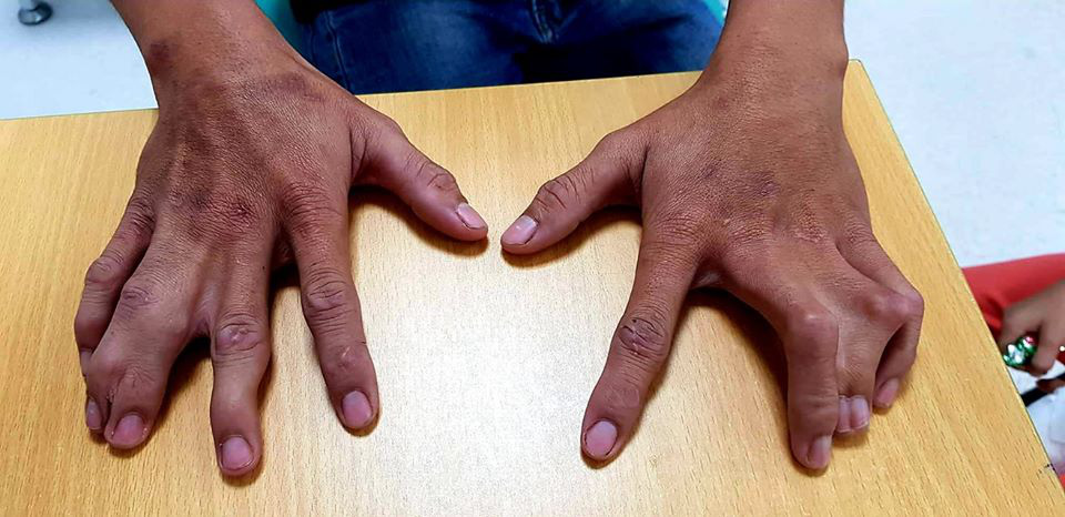 Một d&ograve;ng họ ở Tiền Giang bị dị tật c&agrave;ng cua hiếm gặp - Ảnh 4.