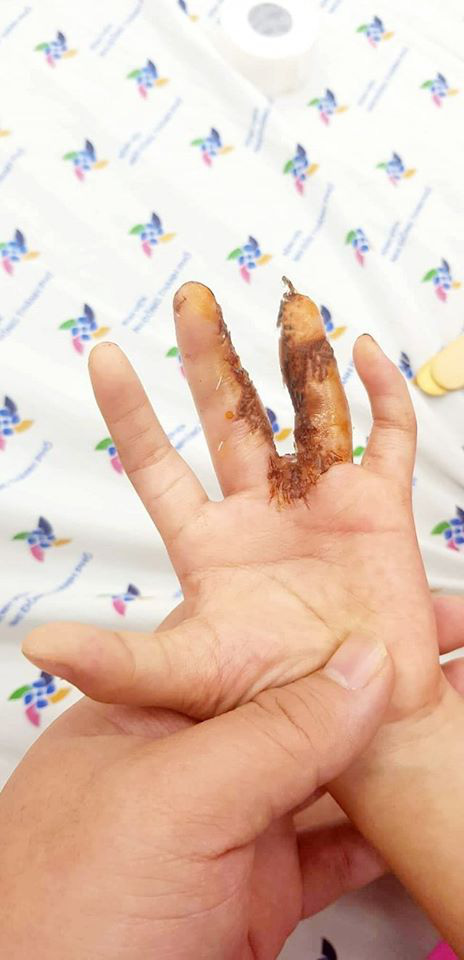 Một d&ograve;ng họ ở Tiền Giang bị dị tật c&agrave;ng cua hiếm gặp - Ảnh 5.